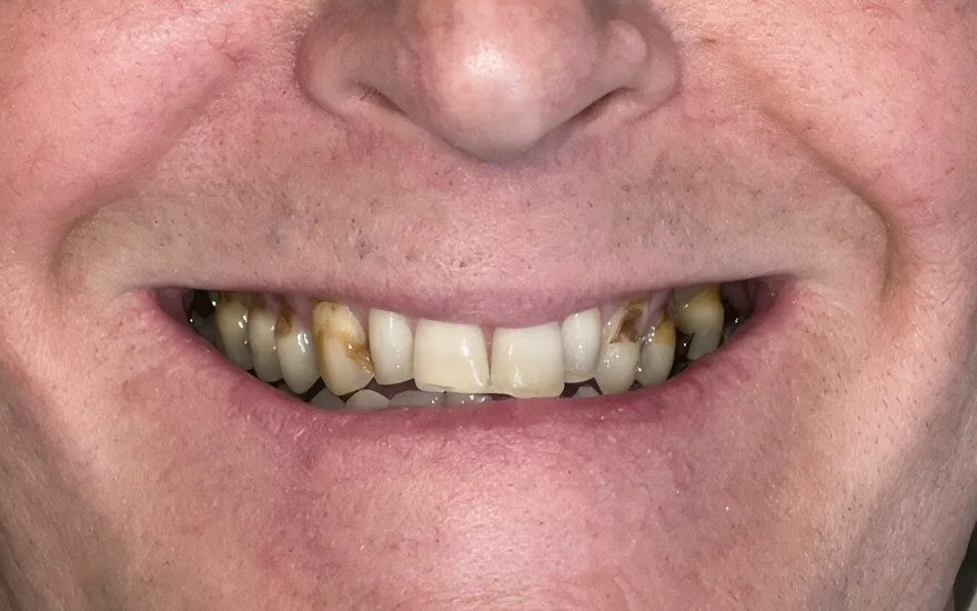 Full-face before and after of a complete smile transformation