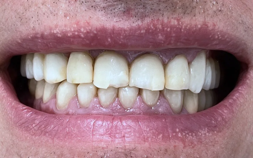 Before and after of a complete upper and lower rehabilitation