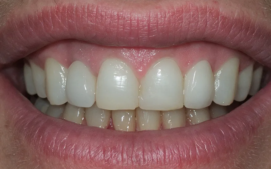 Before and after of porcelain veneers with natural translucency