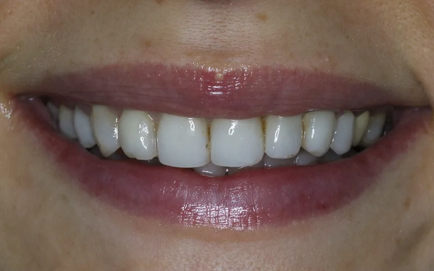Before and after of a single failing front tooth restored
