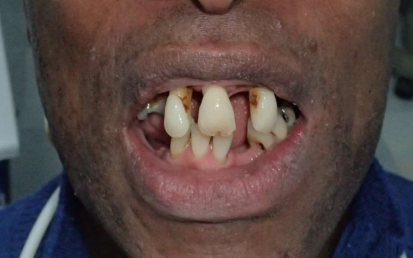 Four-stage sequence of failing front teeth restored with crowns